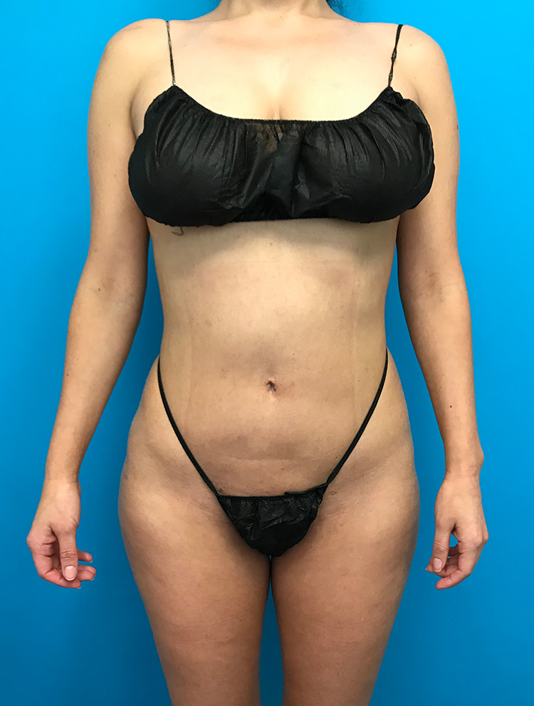 Liposuction result at Dr. Cat Plastic Surgery