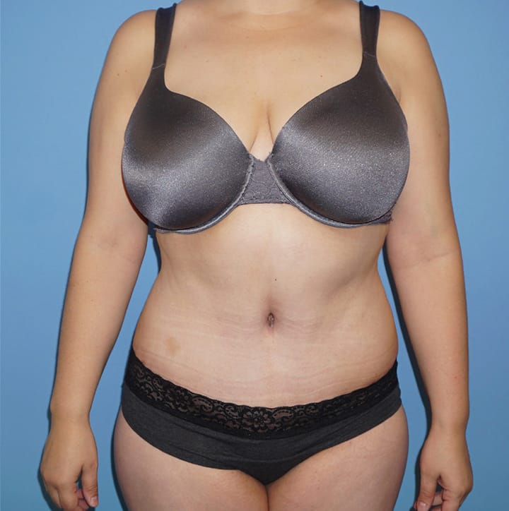 Mommy Makeover result at Dr. Cat Plastic Surgery