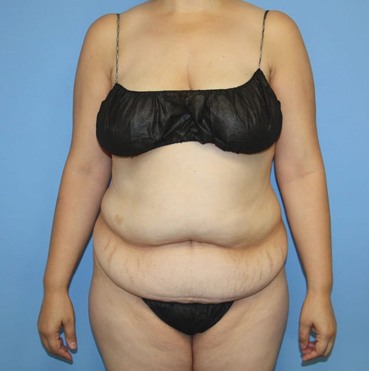 Mommy Makeover before photo