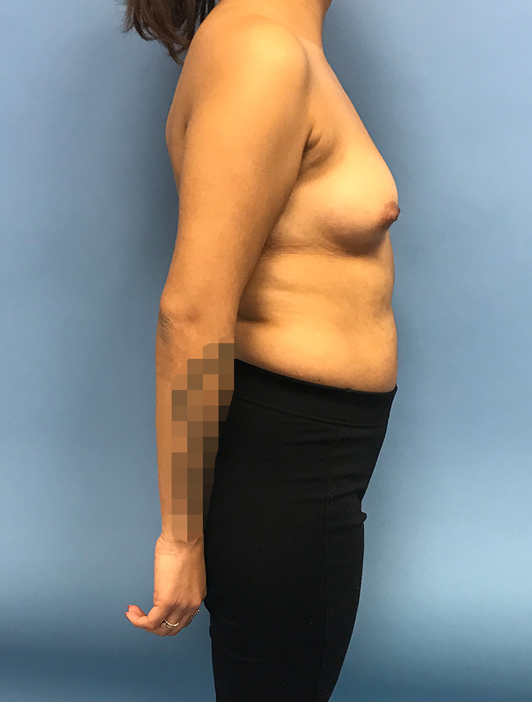 Breast Augmentation before photo