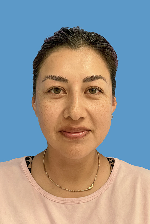 Liposuction result at Dr. Cat Plastic Surgery