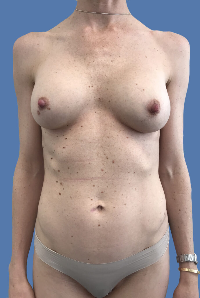 Breast Augmentation result at Dr. Cat Plastic Surgery