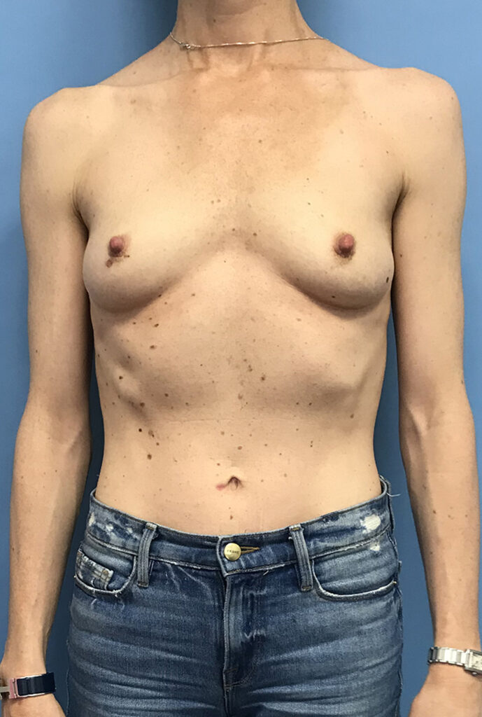 Breast Augmentation before photo