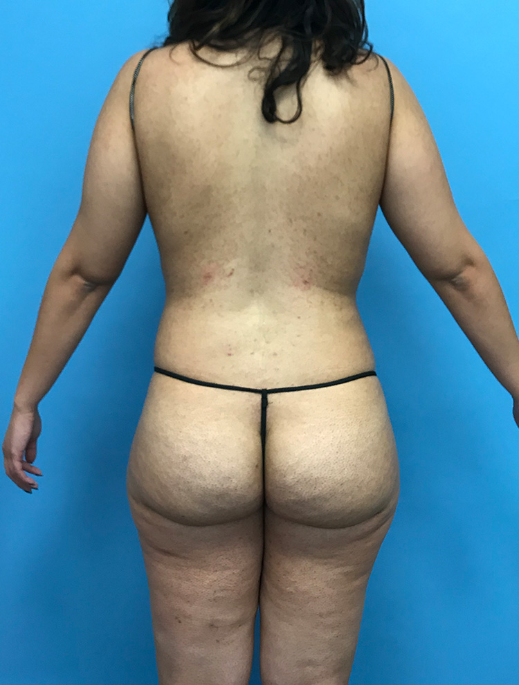 Dr. Cat Plastic Surgery liposuction after — Beverly Hills, CA