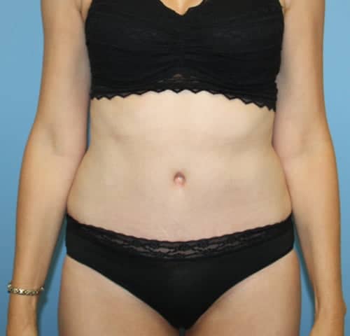 Mommy Makeover result at Dr. Cat Plastic Surgery