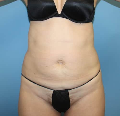 Mommy Makeover before photo