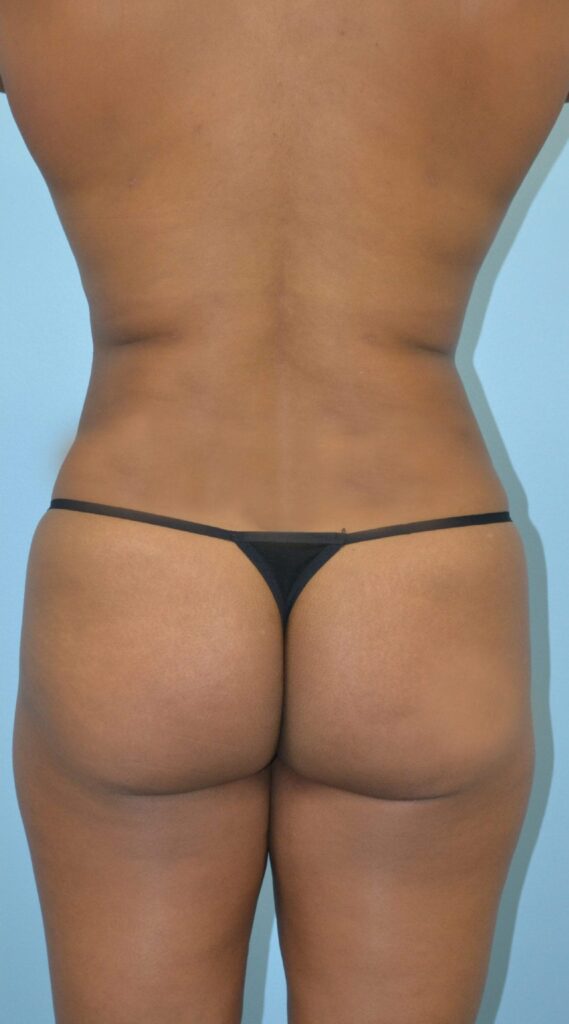 Liposuction result at Dr. Cat Plastic Surgery