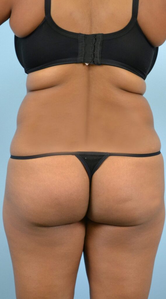 Liposuction before photo