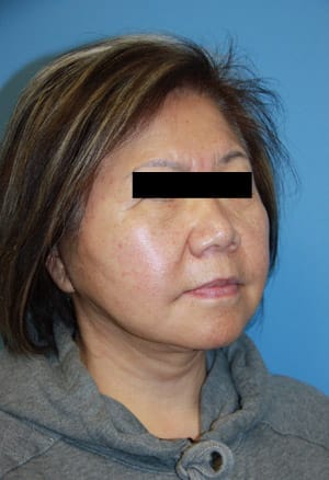 Dr. Cat Plastic Surgery facelift after — Beverly Hills, CA