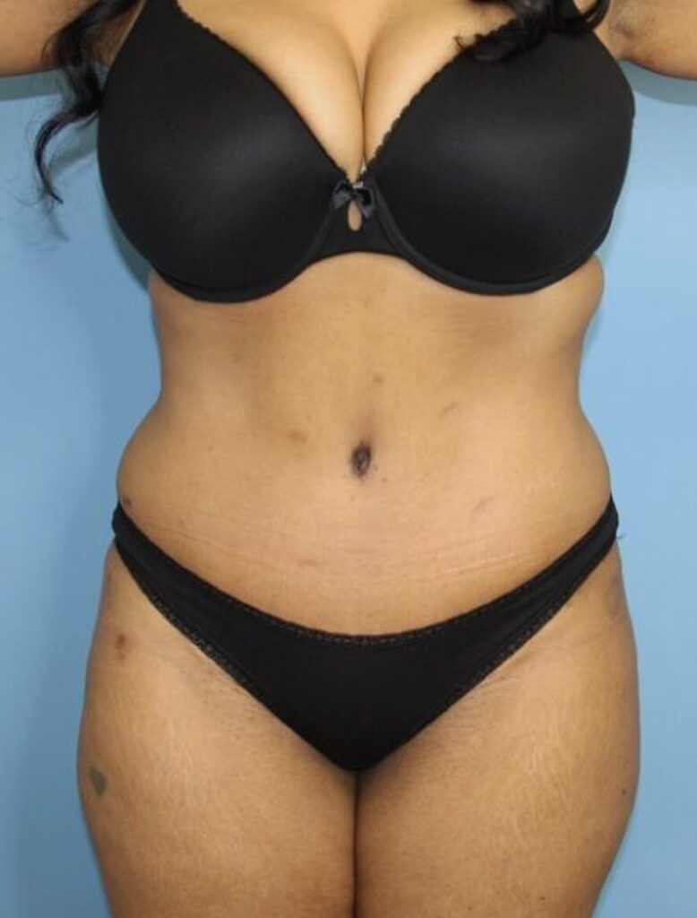 Mommy Makeover result at Dr. Cat Plastic Surgery