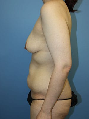 Mommy Makeover before photo