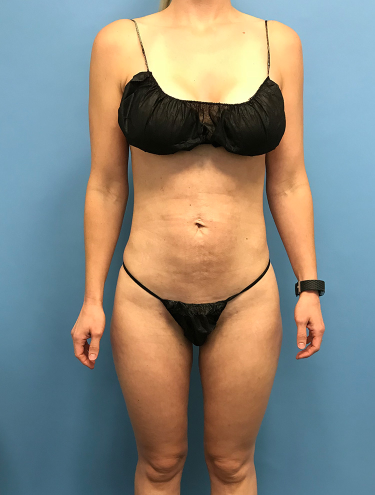 Liposuction result at Dr. Cat Plastic Surgery