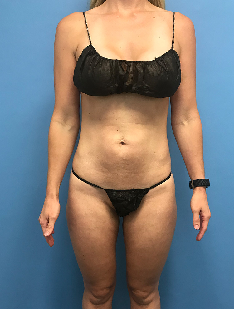 Liposuction before photo