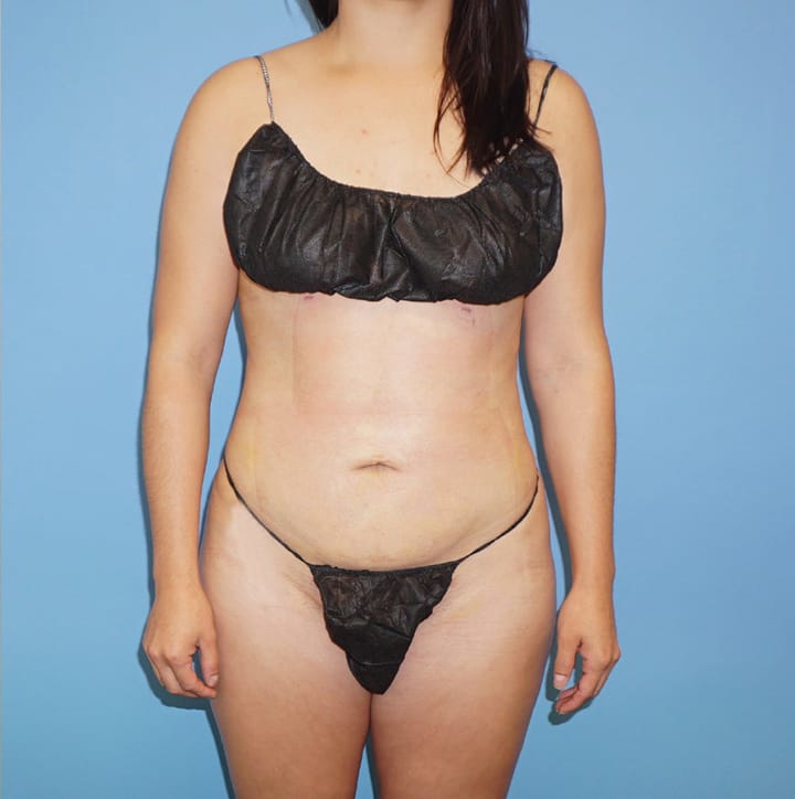 Dr. Cat Plastic Surgery liposuction after — Beverly Hills, CA