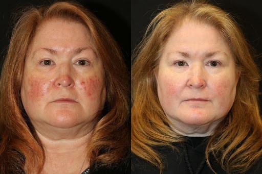 A result from Chernoff Cosmetic Surgery