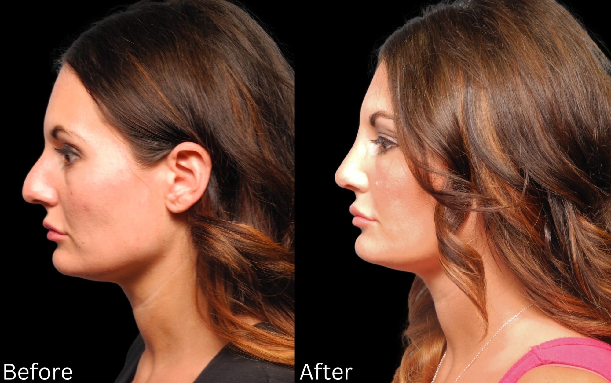 A result from Chernoff Cosmetic Surgery