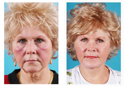 A result from Mobley MD Facial Plastic Surgery