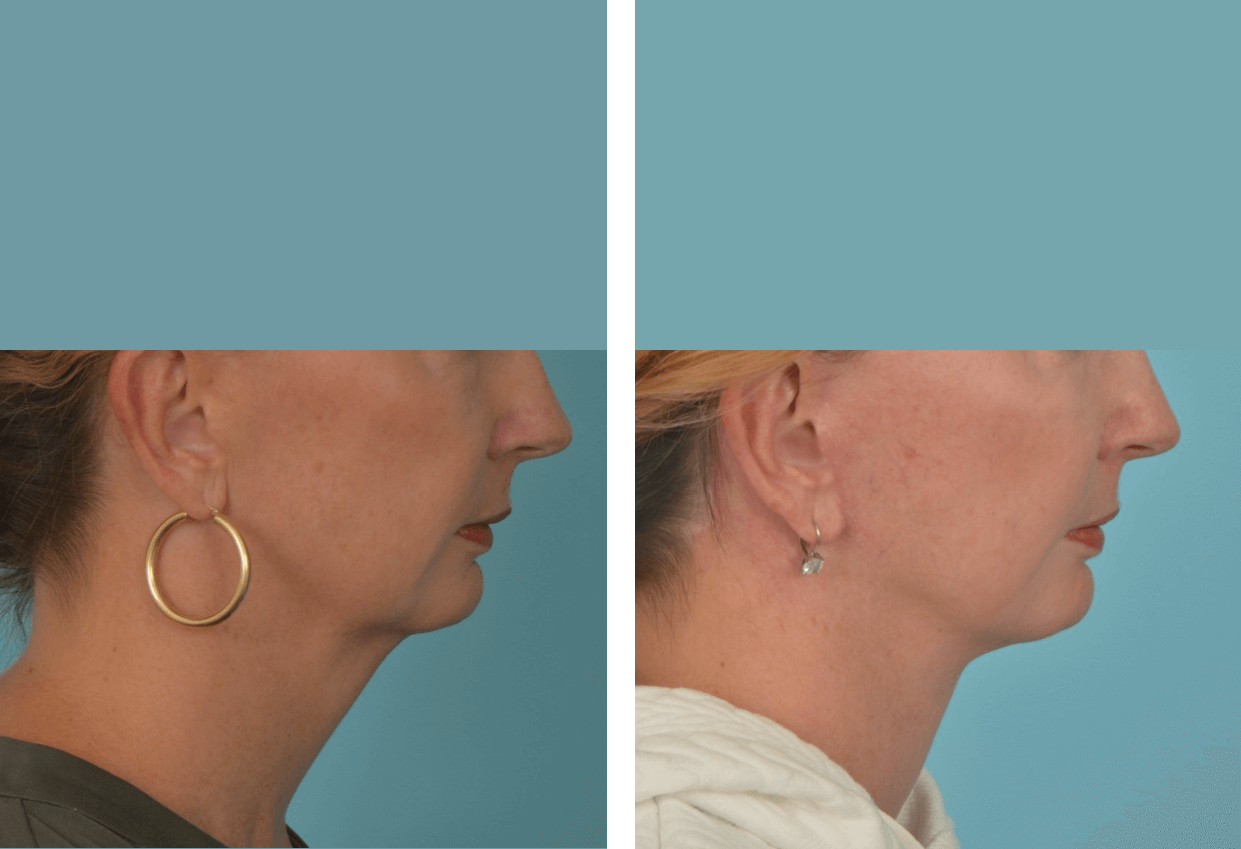 A result from Mobley MD Facial Plastic Surgery