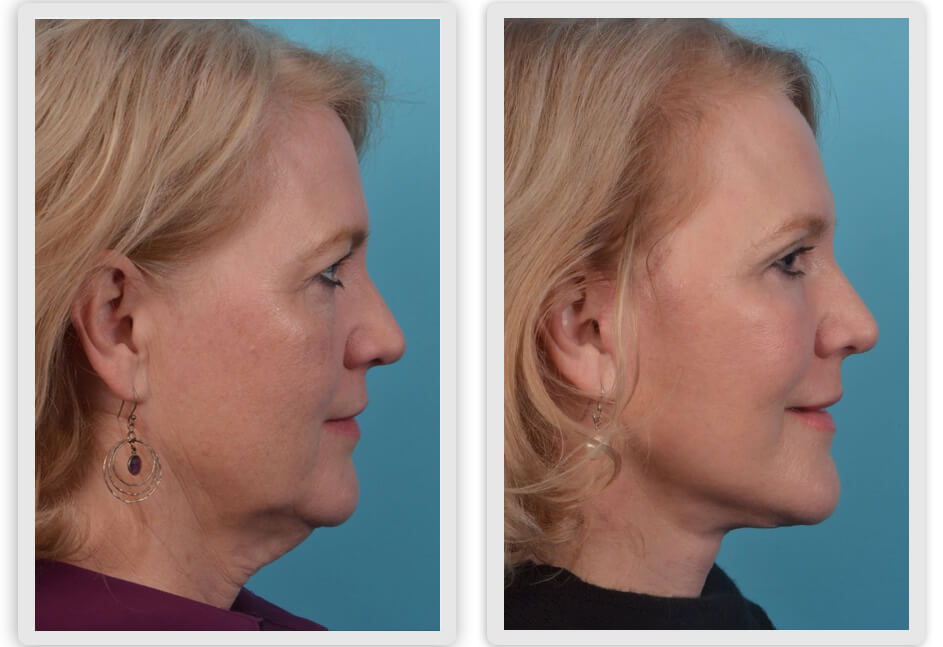 A result from Mobley MD Facial Plastic Surgery