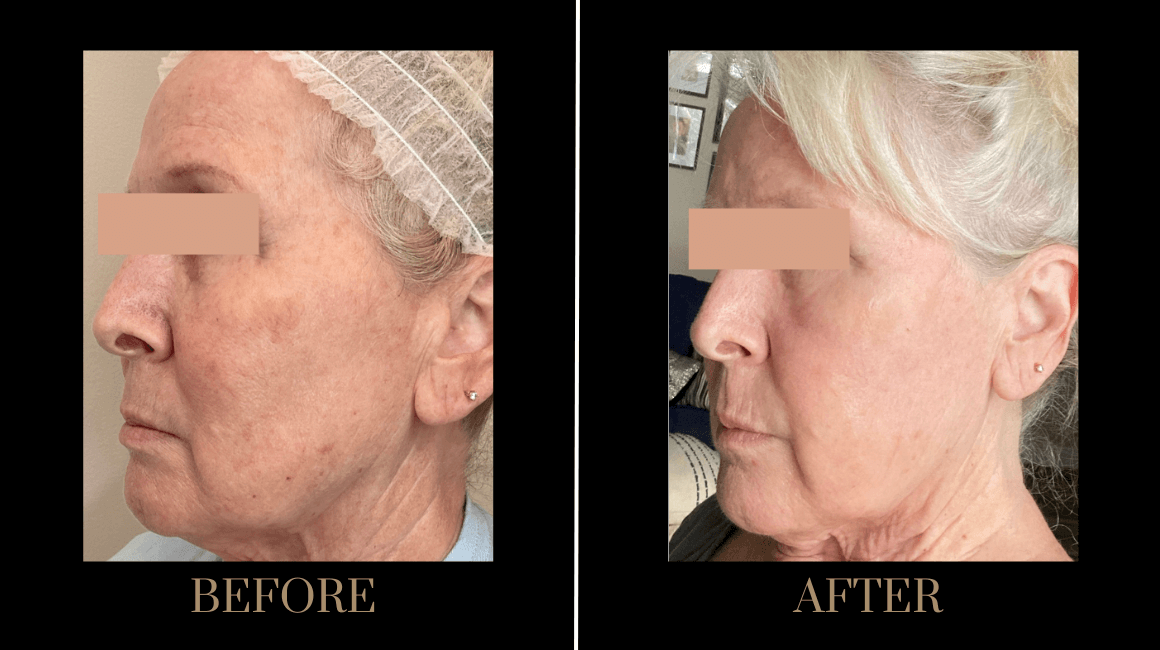 A result from PURE Medical Spa