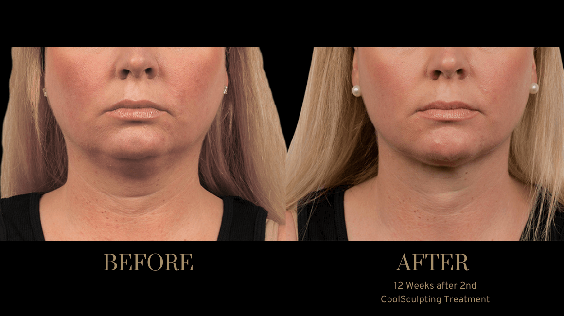 A result from PURE Medical Spa