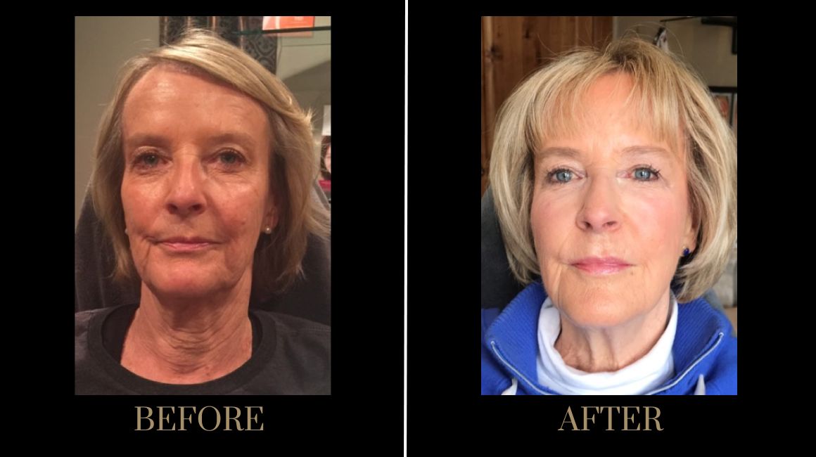 A result from PURE Medical Spa
