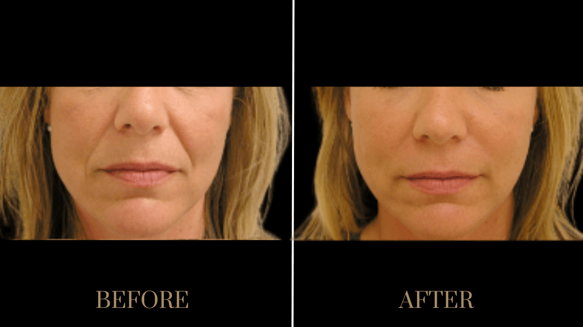 A result from PURE Medical Spa
