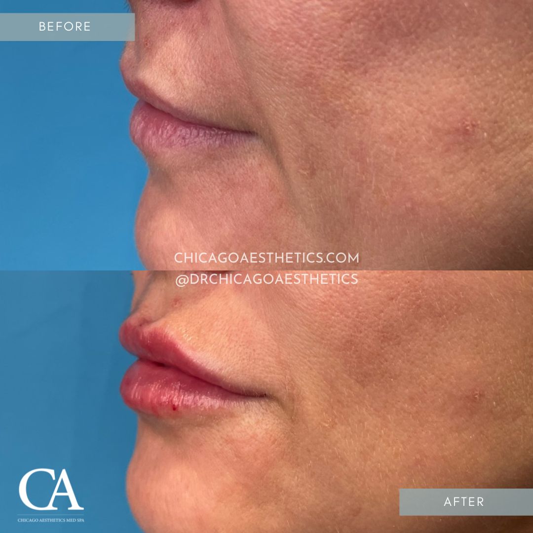 A result from Chicago Aesthetics Surgery & Med Spa