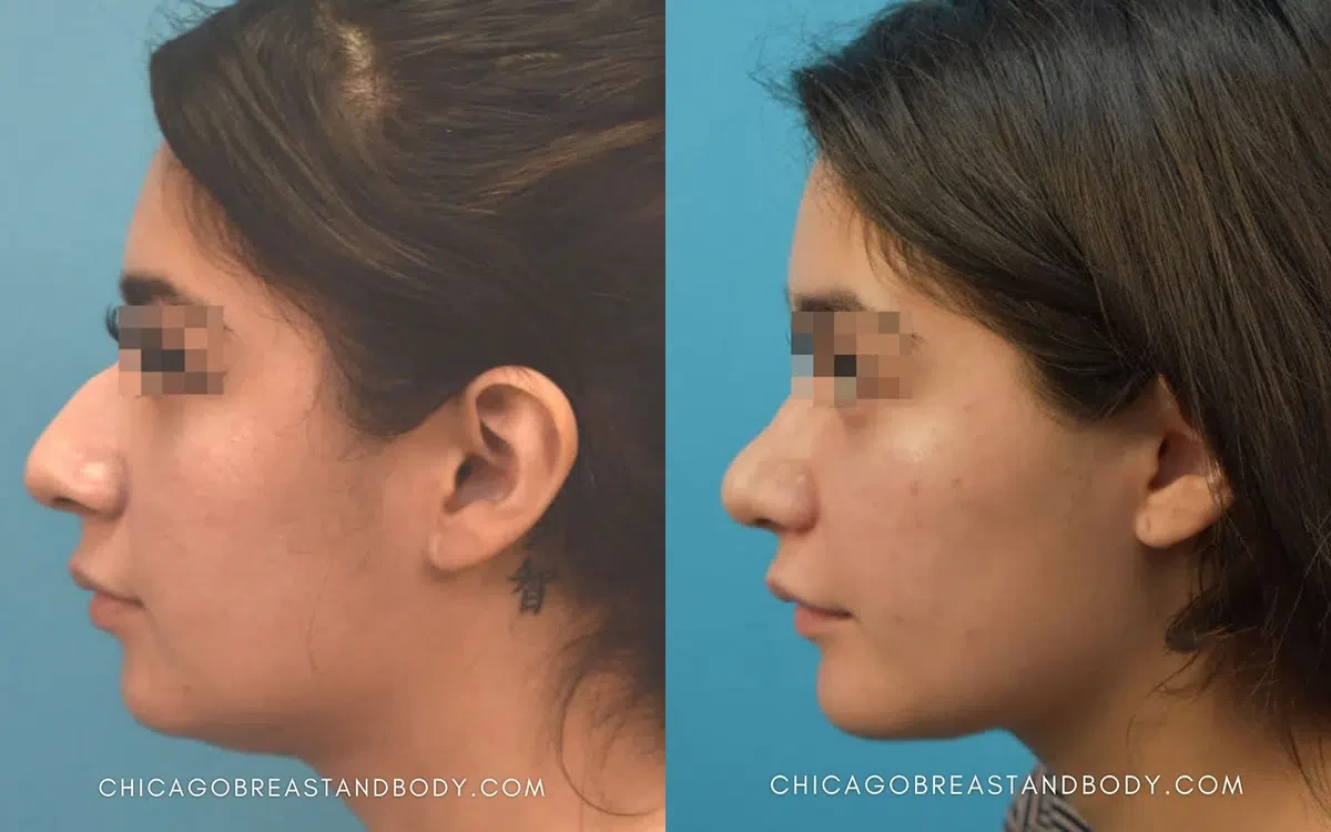 A result from Chicago Aesthetics Surgery & Med Spa