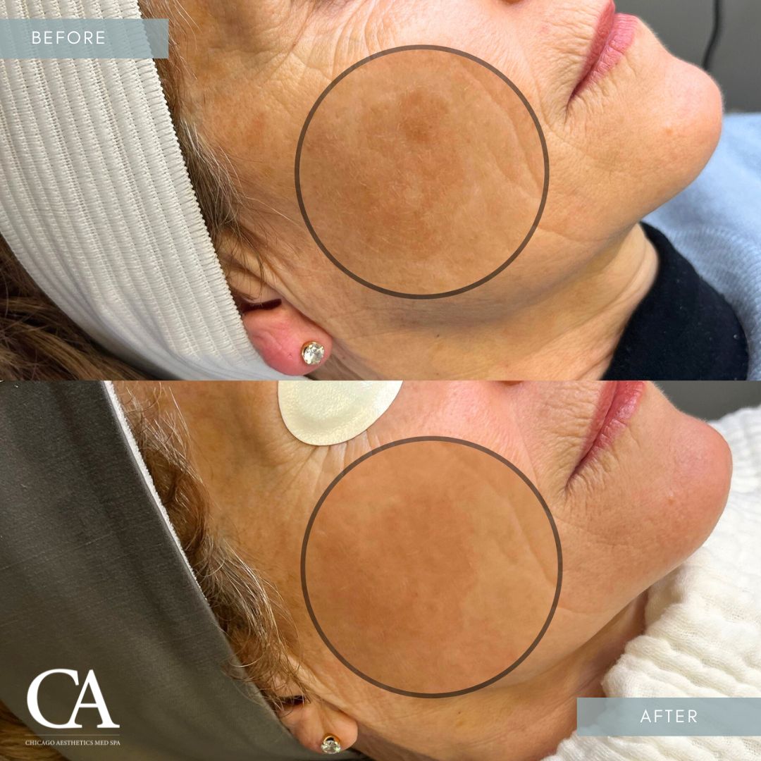 A result from Chicago Aesthetics Surgery & Med Spa