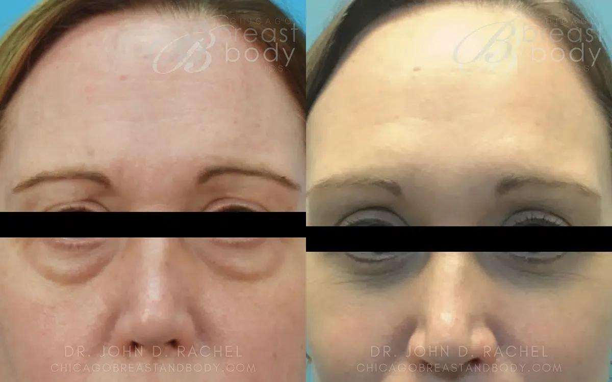 A result from Chicago Aesthetics Surgery & Med Spa