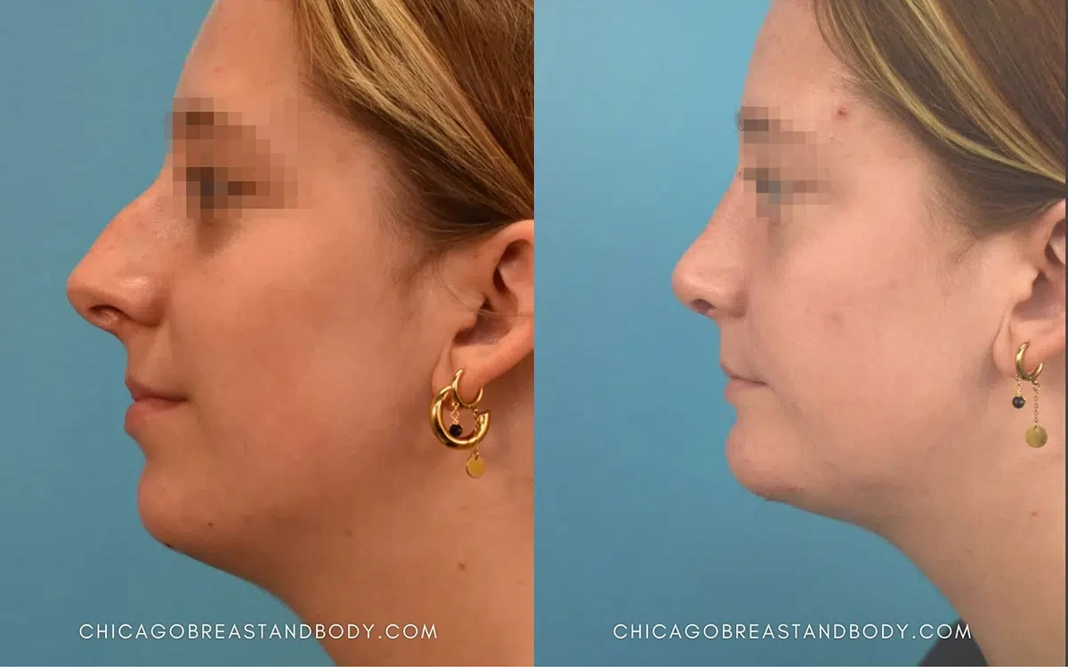 A result from Chicago Aesthetics Surgery & Med Spa