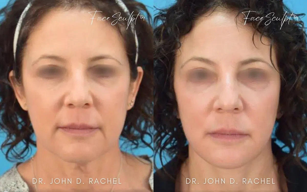 A result from Chicago Aesthetics Surgery & Med Spa