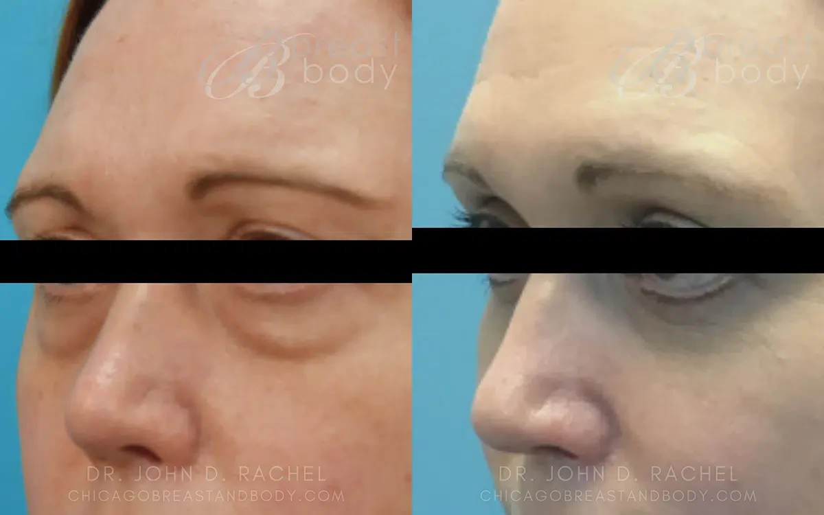 A result from Chicago Aesthetics Surgery & Med Spa