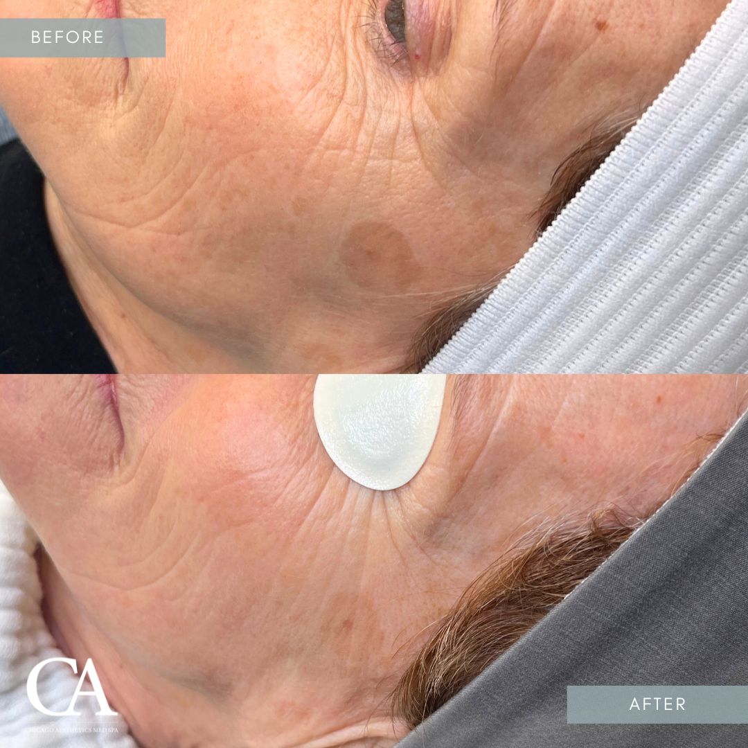 A result from Chicago Aesthetics Surgery & Med Spa