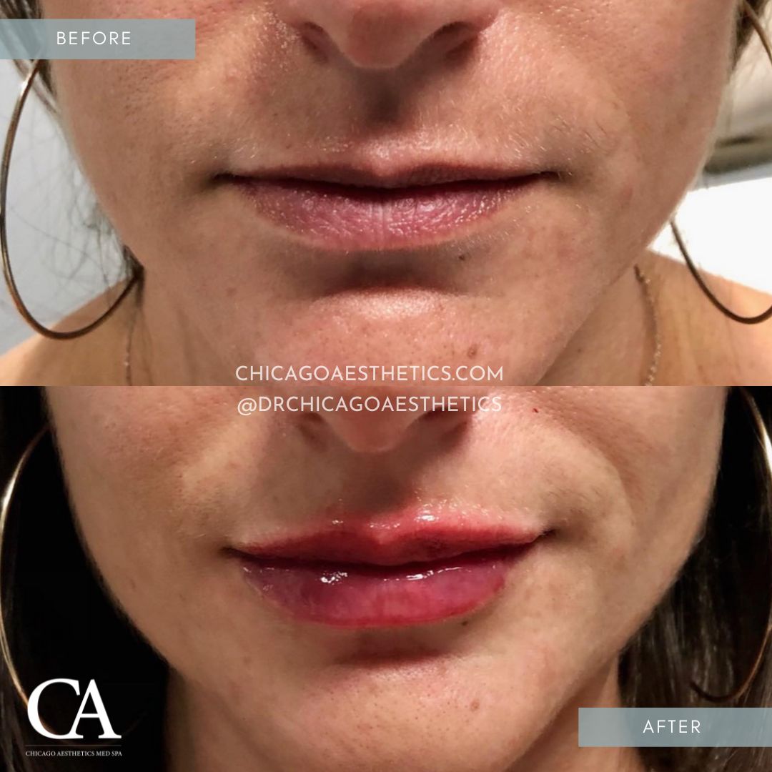 A result from Chicago Aesthetics Surgery & Med Spa