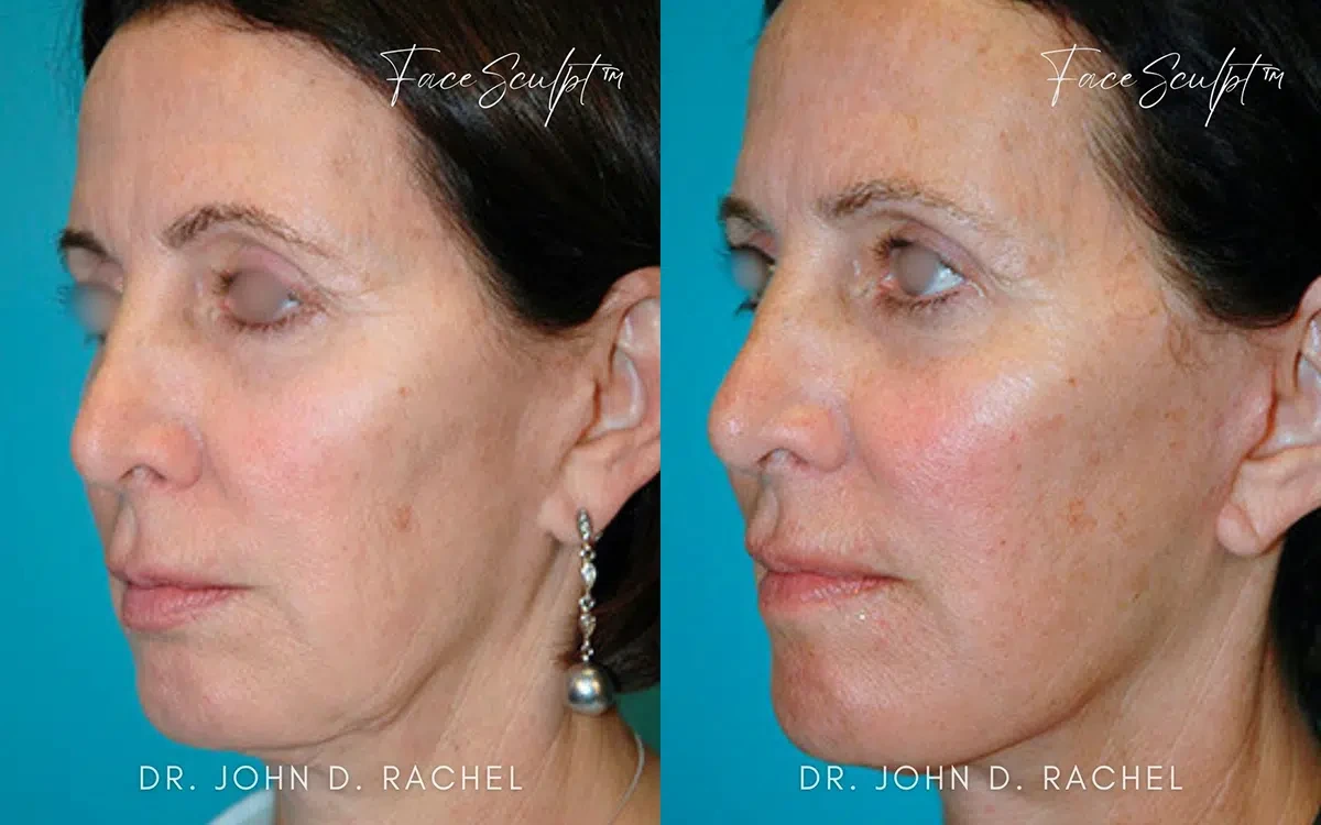 A result from Chicago Aesthetics Surgery & Med Spa