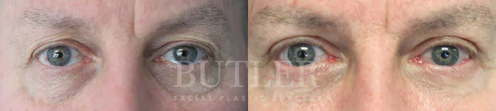 Blepharoplasty result at Butler Facial Plastic Surgery