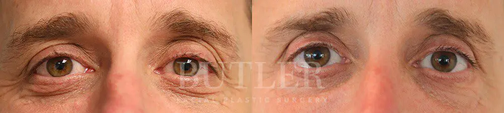 Blepharoplasty result at Butler Facial Plastic Surgery