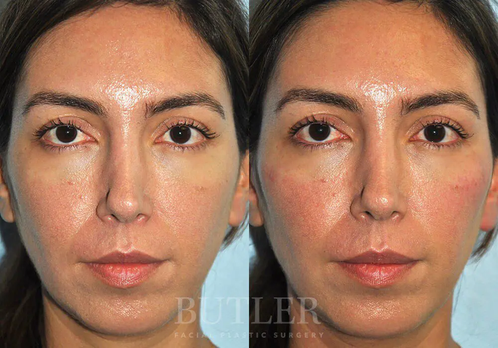 Cheek Filler result at Butler Facial Plastic Surgery