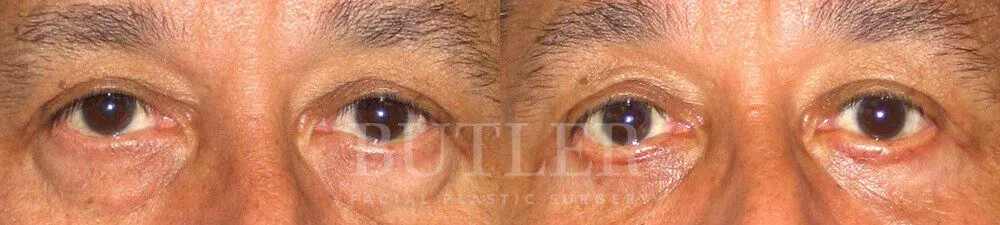 Blepharoplasty result at Butler Facial Plastic Surgery