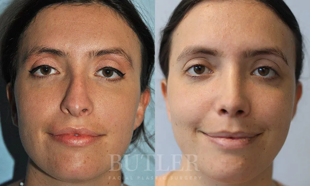 Rhinoplasty result at Butler Facial Plastic Surgery