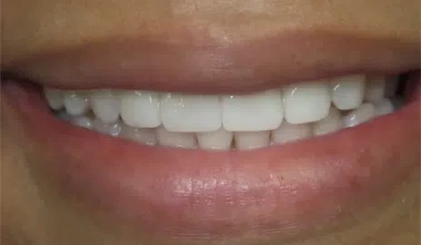 A result from Fifth Avenue Dental Arts