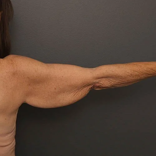 Liposuction before photo