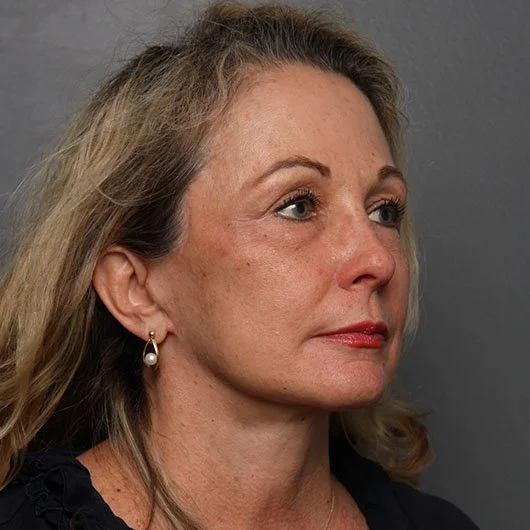 Angela Keen | Utah Aesthetic Surgery facelift after — Cottonwood Heights, UT