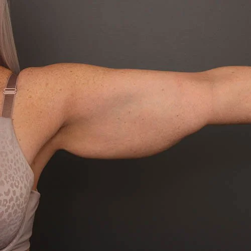 Arm Lift before photo