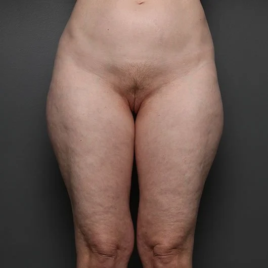 Liposuction before photo