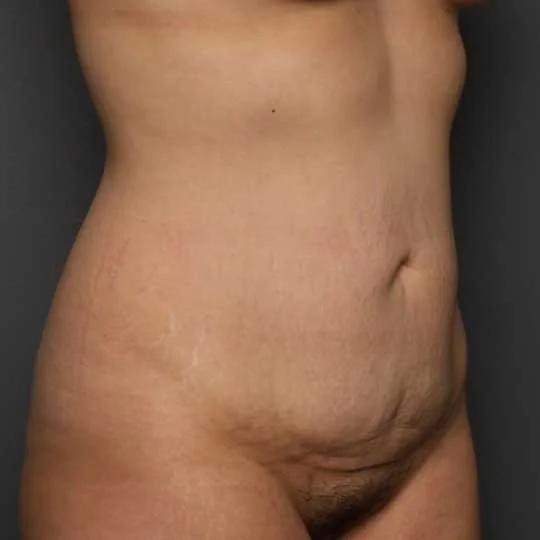 Tummy Tuck before photo
