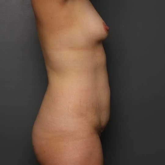 Tummy Tuck before photo
