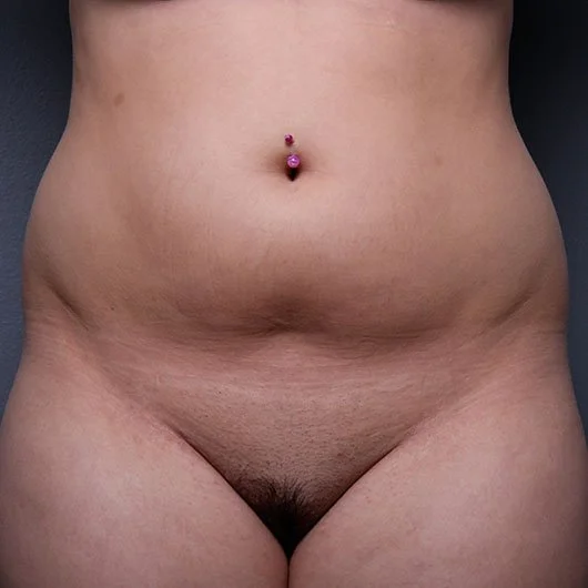Liposuction before photo